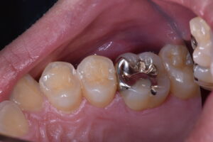通常の銀歯による歯科治療