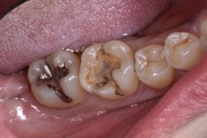 銀歯の下の二次虫歯