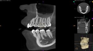 ダイレクトボンディングの術前CT