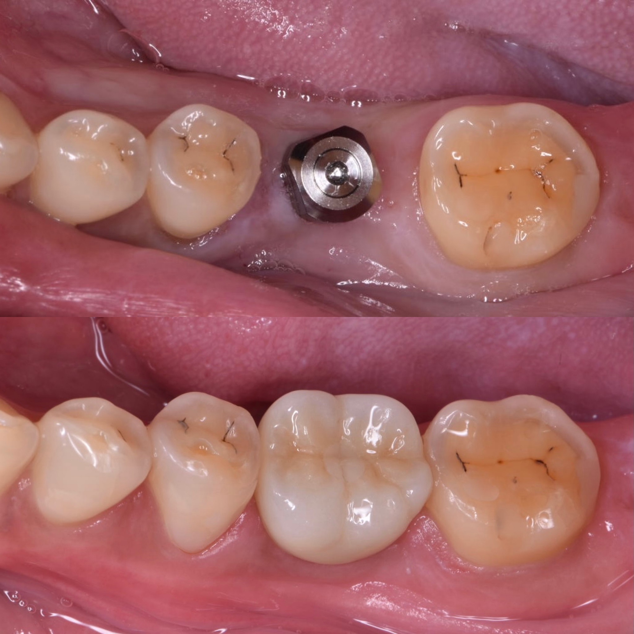 診療へのこだわり（インプラント編） | 99.9 Dental Clinic